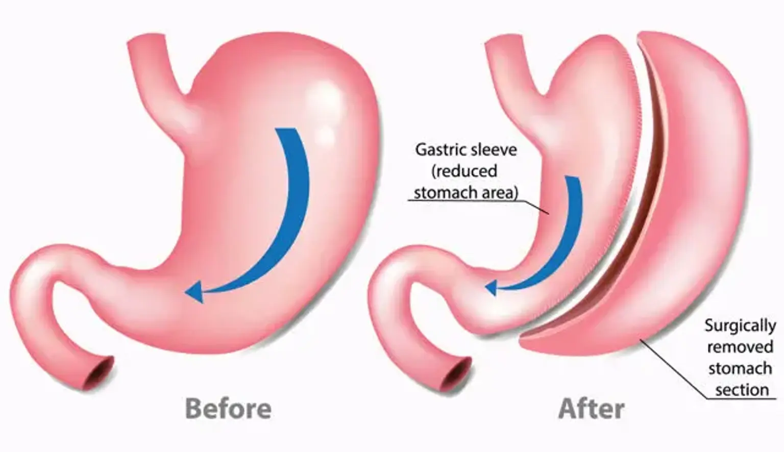 Home 1 sleeve gastrectomy